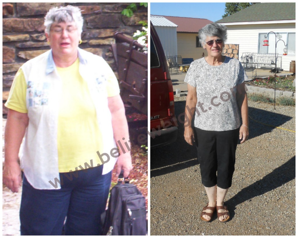 Carolyn Before and After Medicare Paid Gastric Bypass Surgery | BeLiteWeight | Weight Loss Services
