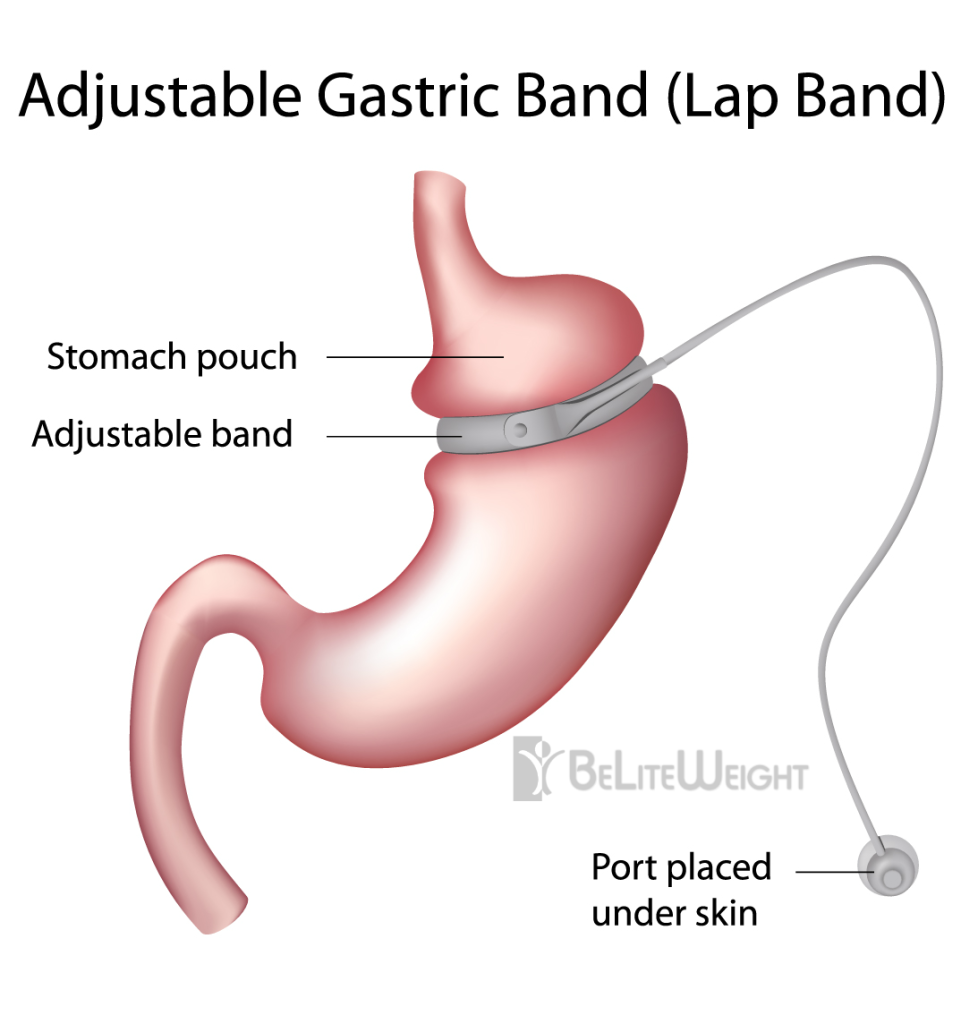 Lap-Band-Gastric-Band