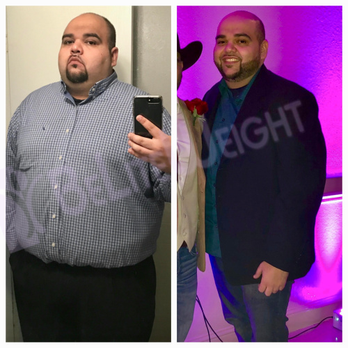 weight loss surgery before after vsg gastiric sleeve