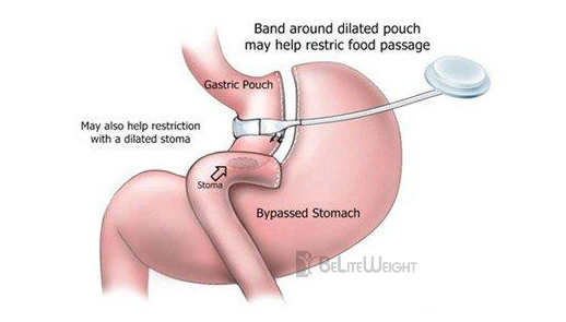 Band Over Bypass Weight Loss Surgery Revision