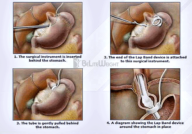 Gastric Band - Lap Band Surgical Procedure