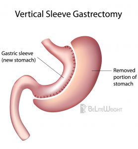 Gastric Sleeve - Vertical Sleeve Gastrectomy