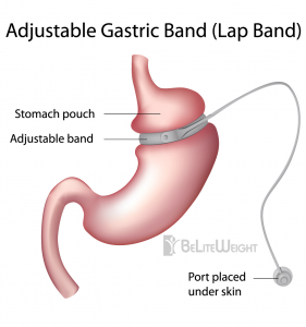 Lap Band - Gastric Band