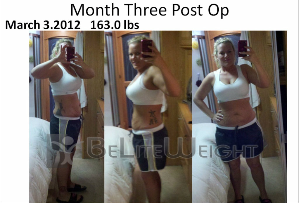 Weight Loss in Progress: Sonya's Update After Gastric Sleeve Surgery -  BeLiteWeight