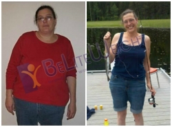 weight loss surgery success before and after