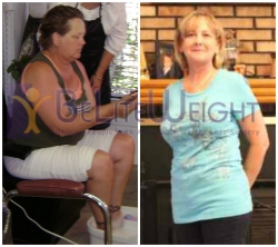 Best Gastric Sleeve Revision in USA, California