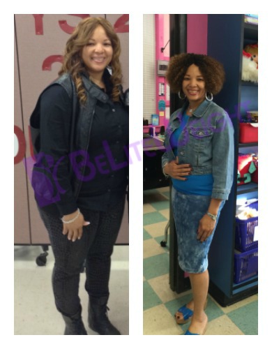 weight loss surgery vsg vertical gastric sleeve before after 1 year