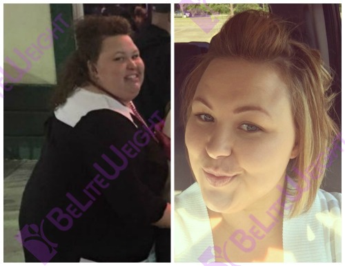weight loss surgeyr before and after gastric bariatric bypass sleeve band wls before after rachel 8 months