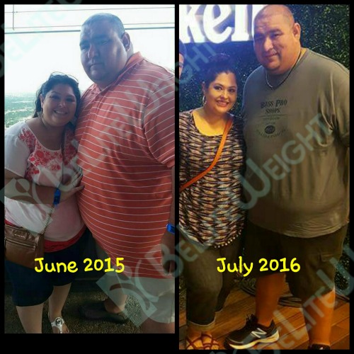 weight loss surgery before after vsg bariatric eduardo and maria