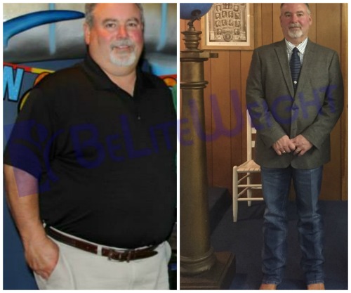 weight loss surgery vsg vertical gastric sleeve before and after