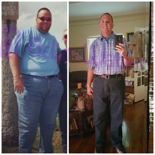 before and after weight loss surgery gasrtic sleeve bypass band reux en