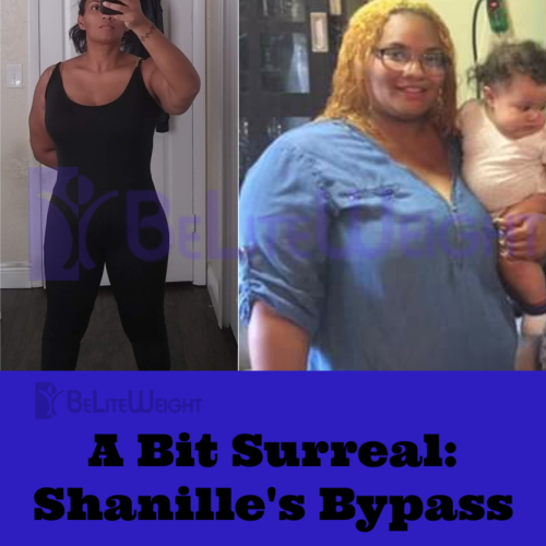 shanille before after weight loss surgery gastric bypass sleeve wls