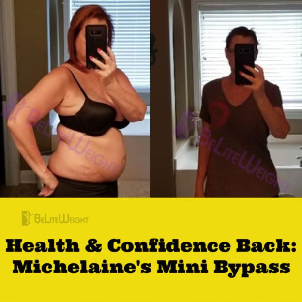 mini bypass gastric weight loss surgery before after vsg