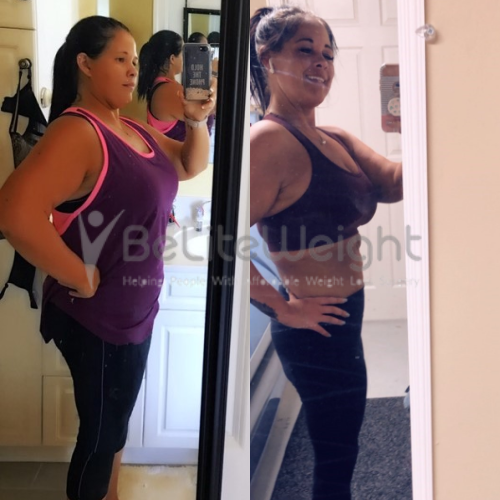 Gastric Sleeve Before and After Photos - The Best Pictures of 2022