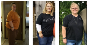 Gastric Bypass Before and After