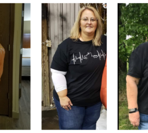 Gastric Bypass Before and After