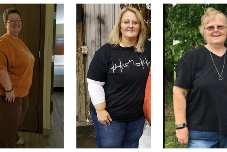 Gastric Bypass Before and After