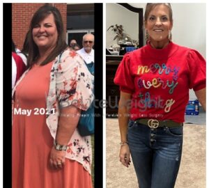 gastric sleeve before and after 3 months