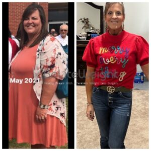 gastric sleeve before and after 3 months