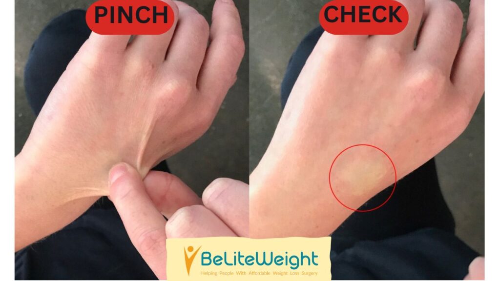 The Pinch Test to Determine Fat or Loose Skin