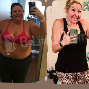 Before And After Gastric Sleeve Surgery