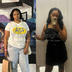 Breya S= Gastric Sleeve Before And After
