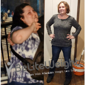 Before And After Gastric Sleeve