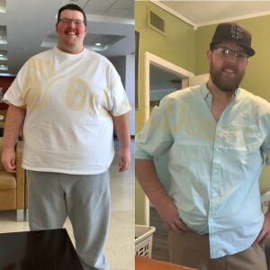 Christopher B= Gastric Sleeve Before And After Male