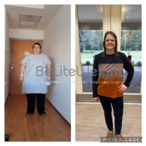 Courtney H= Gastric Sleeve After and Before 