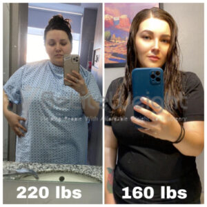 Cristina V= Gastric Sleeve Before And After