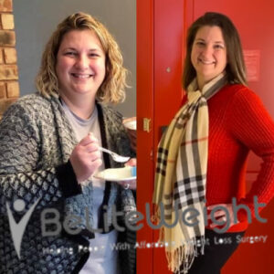 Diane W= Gastric Sleeve Weight Loss Before And After