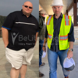 Don L= Gastric Sleeve Before And After