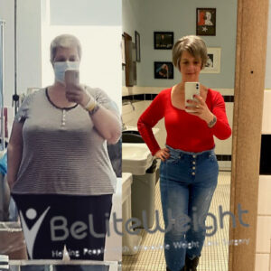 Donna C= Gastric Sleeve Surgery Before And After