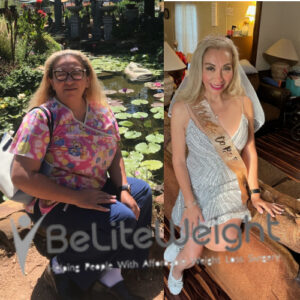 Emilia T= Gastric Sleeve Before And After Skin