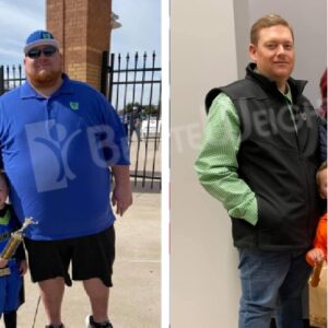 Gastric Sleeve Before And After Male