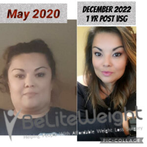 Flor S= Before And After Gastric Sleeve
