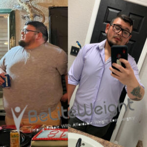 Gerardo R= gastric sleeve before and after pictures