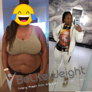 Jelisa S= Gastric Sleeve Before And After Pictures