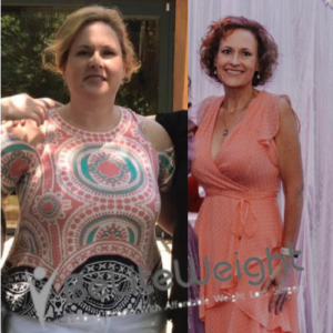 Gastric Sleeve Surgery Before And After