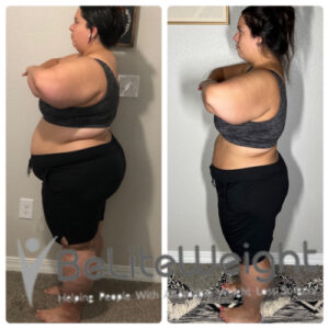 Jessica A= Gastric Sleeve Before And After 6 Months