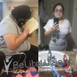 Joanna G= Gastric Sleeve Surgery Before And After
