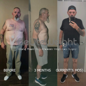 Jamie R= Gastric Sleeve Surgery Before And After