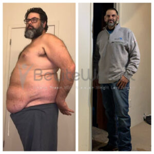 Jericho D= Gastric Sleeve Before And After