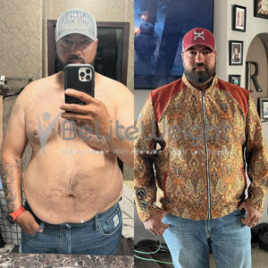 Jesse R= Gastric Sleeve Before And After Pictures