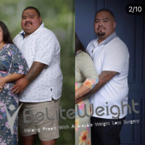 John S= Before And After Gastric Sleeve Surgery