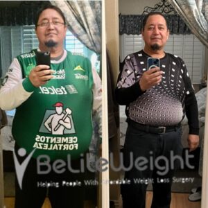 Jose Z= Gastric Sleeve Before And After 6 Months