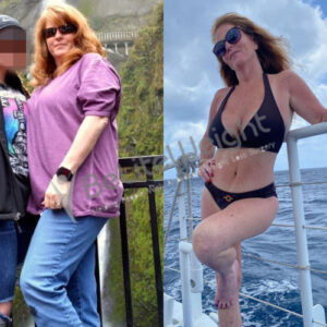 Joy H= Gastric Sleeve After and Before