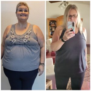 Karri M= Gastric Sleeve Before And After