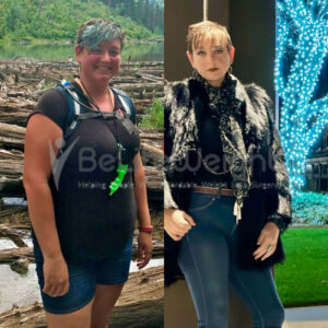 Katarina R - Gastric Sleeve Before and After