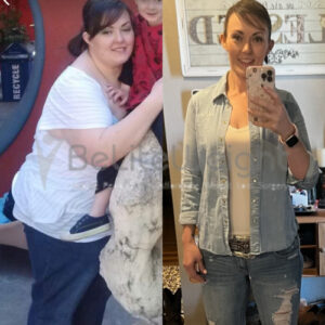 Kimberly R= Gastric Sleeve Before And After